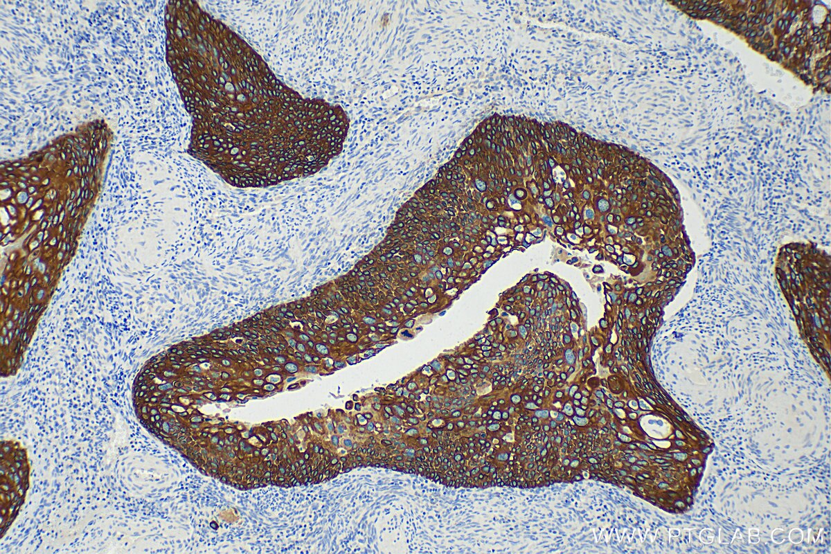 Immunohistochemistry (IHC) staining of human cervical cancer tissue using Cytokeratin 14 Polyclonal antibody (10143-1-AP)