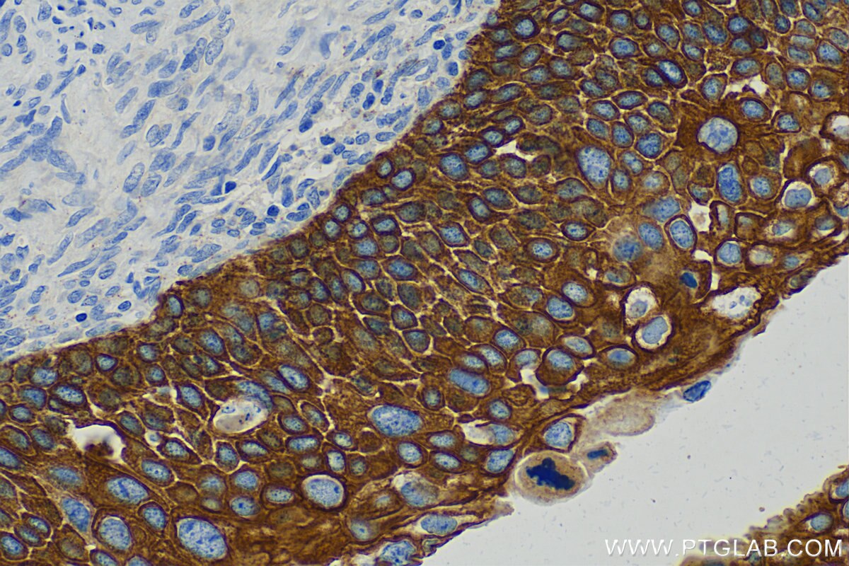 Immunohistochemistry (IHC) staining of human cervical cancer tissue using Cytokeratin 14 Polyclonal antibody (10143-1-AP)