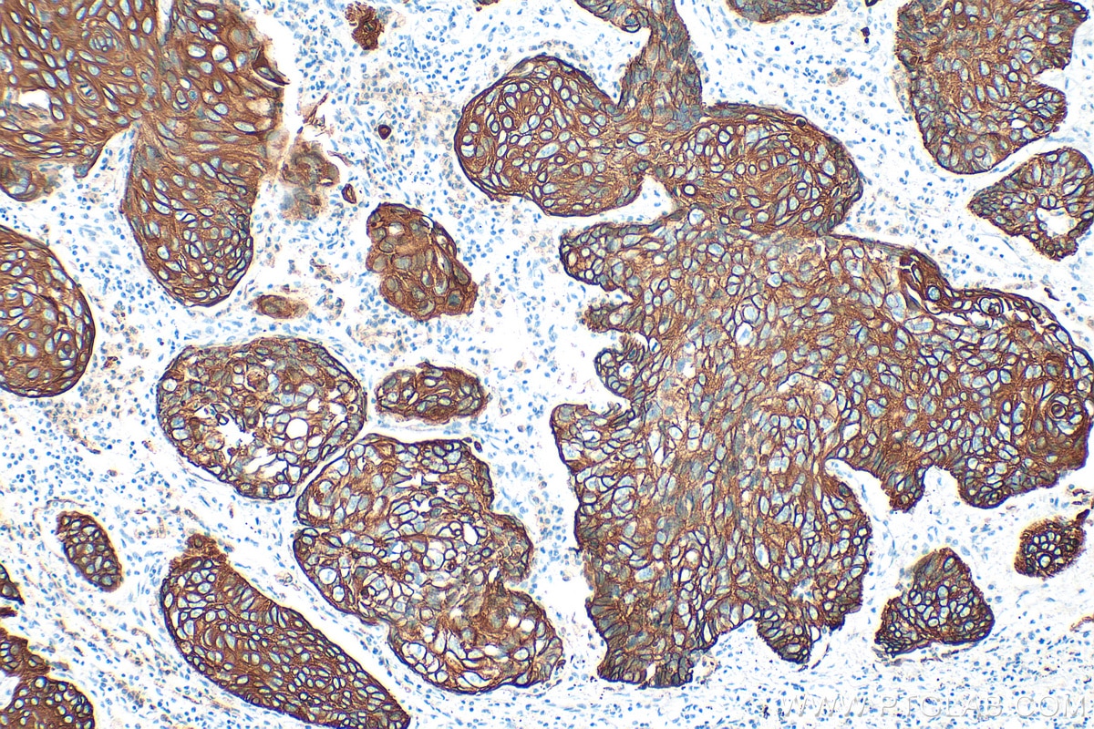 IHC staining of human lung cancer using 10143-1-AP