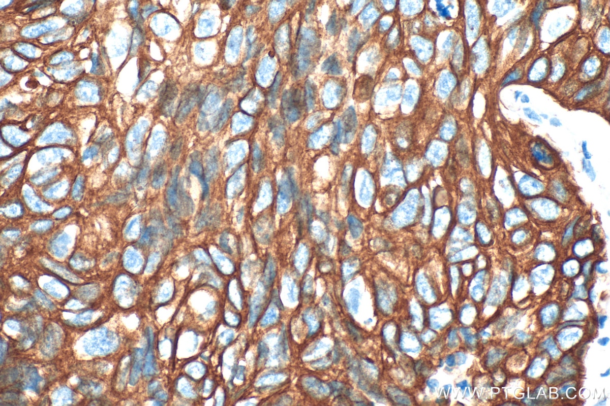 IHC staining of human lung cancer using 10143-1-AP