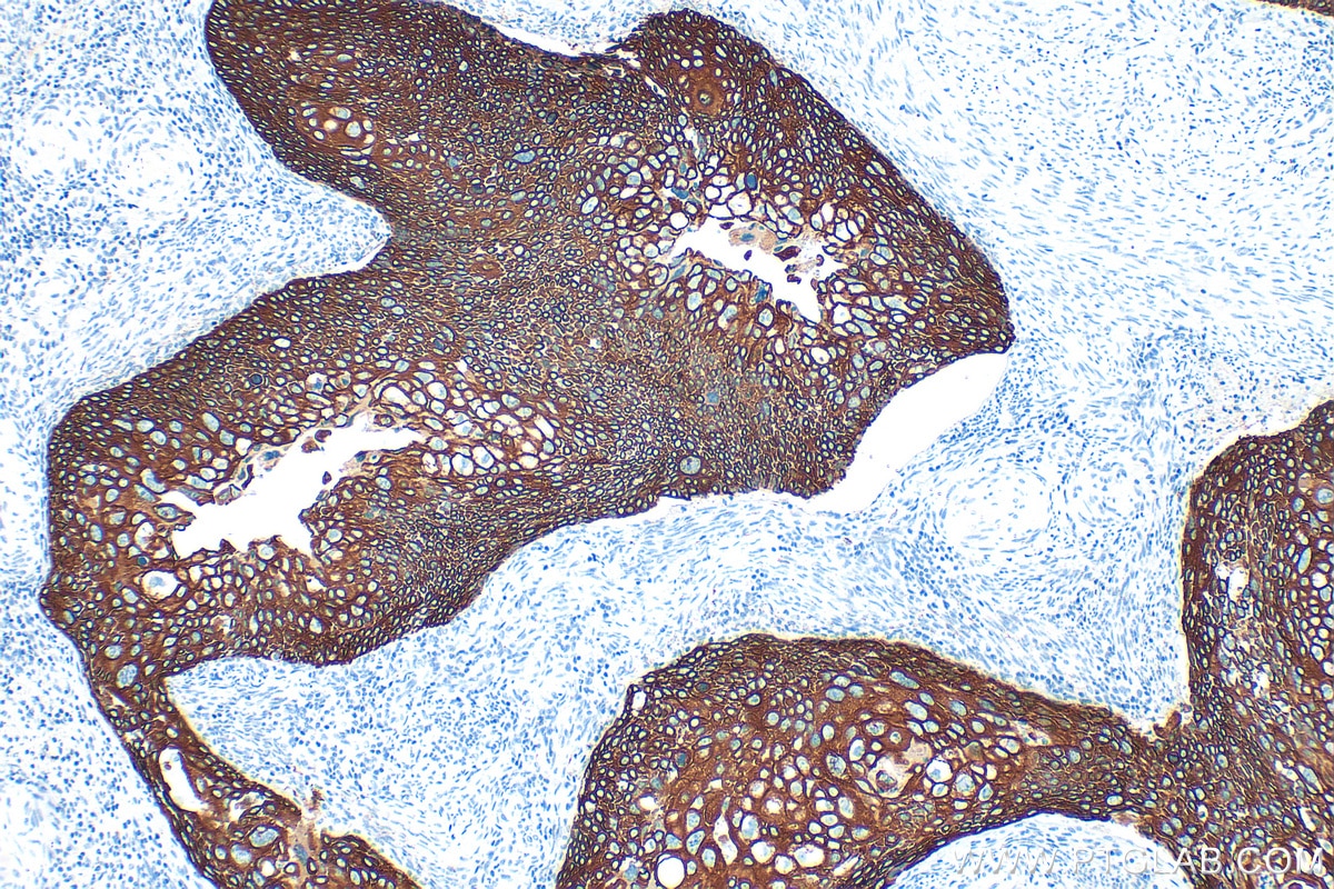 Immunohistochemistry (IHC) staining of human cervical cancer tissue using Cytokeratin 14 Polyclonal antibody (10143-1-AP)