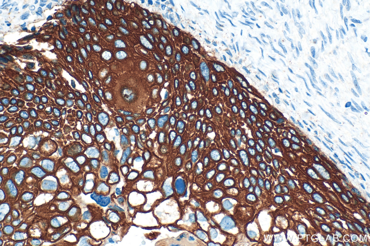 IHC staining of human cervical cancer using 10143-1-AP