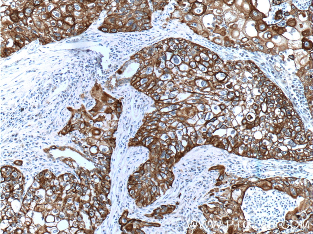 IHC staining of human lung cancer using 10143-1-AP