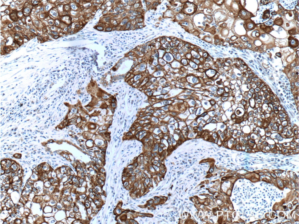 Immunohistochemistry (IHC) staining of human lung cancer tissue using Cytokeratin 14 Polyclonal antibody (10143-1-AP)