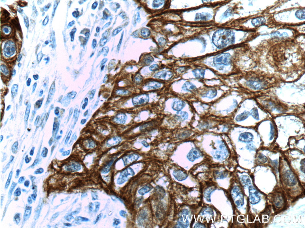 Immunohistochemistry (IHC) staining of human lung cancer tissue using Cytokeratin 14 Polyclonal antibody (10143-1-AP)