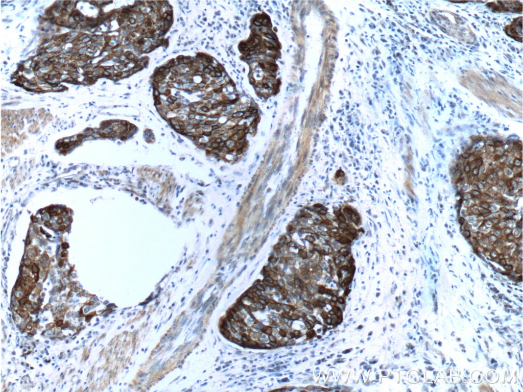 Immunohistochemistry (IHC) staining of human oesophagus cancer tissue using Cytokeratin 14 Polyclonal antibody (10143-1-AP)