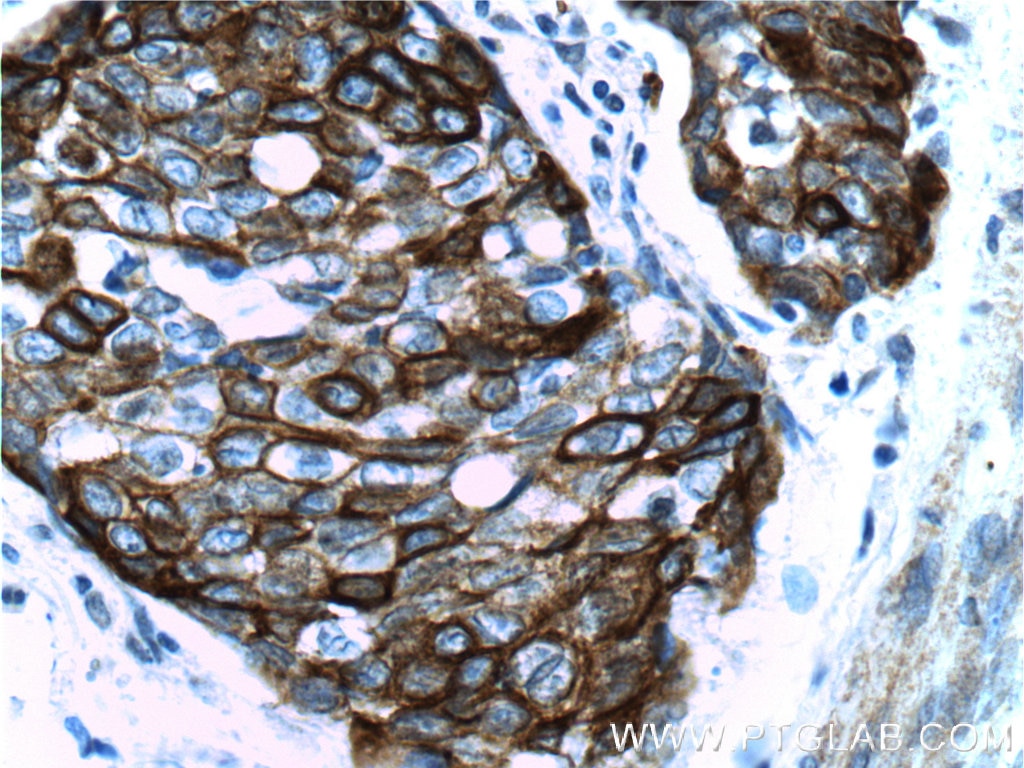 Immunohistochemistry (IHC) staining of human oesophagus cancer tissue using Cytokeratin 14 Polyclonal antibody (10143-1-AP)