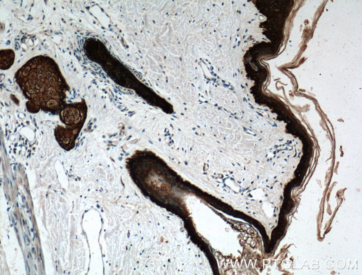 Immunohistochemistry (IHC) staining of human skin tissue using Cytokeratin 14 Polyclonal antibody (10143-1-AP)