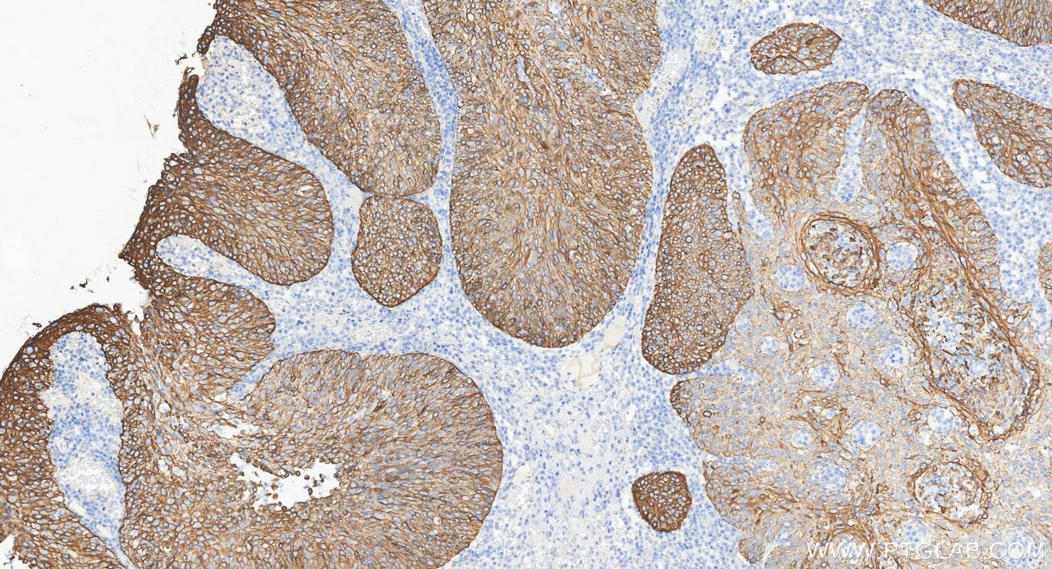 Immunohistochemistry (IHC) staining of human cervical cancer tissue using Cytokeratin 14 Polyclonal antibody (10143-1-AP)