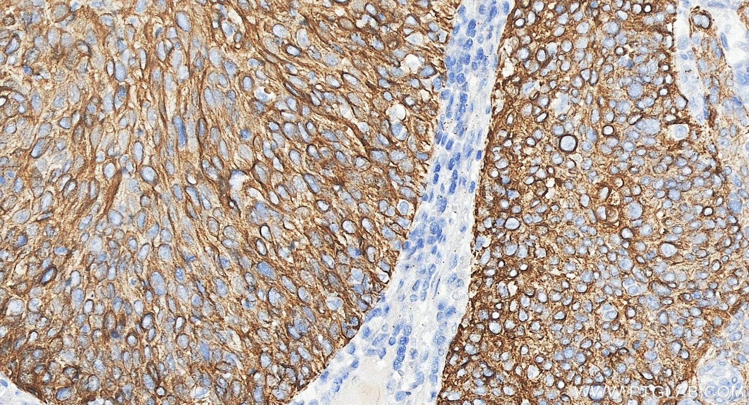 Immunohistochemistry (IHC) staining of human cervical cancer tissue using Cytokeratin 14 Polyclonal antibody (10143-1-AP)