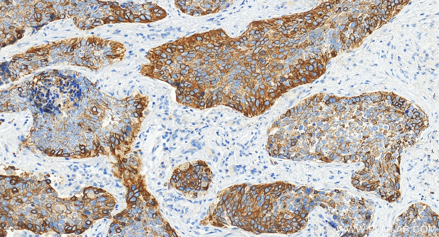Immunohistochemical analysis of paraffin-embedded human lung squamous cell carcinoma tissue slide using 10143-1-AP (Cytokeratin 14 antibody) at dilution of 1:8000 (under 20x lens). Heat mediated antigen retrieval with Tris-EDTA buffer (pH 9.0). Immunohistochemistry (IHC) staining of human lung squamous cell carcinoma tissue using Cytokeratin 14 Polyclonal antibody (10143-1-AP)