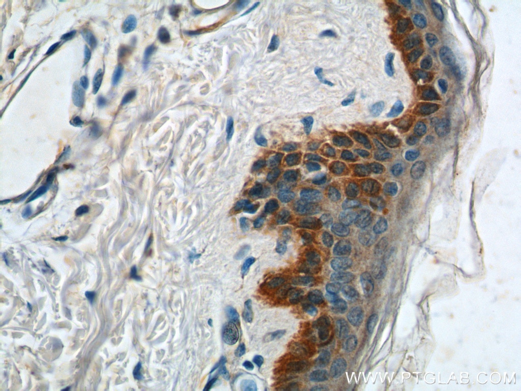 Immunohistochemistry (IHC) staining of human skin tissue using Cytokeratin 14 Polyclonal antibody (22221-1-AP)