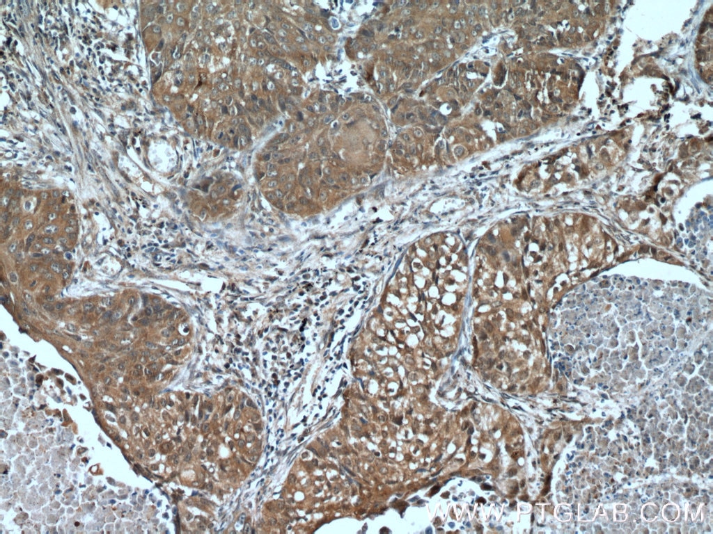 Immunohistochemistry (IHC) staining of human lung cancer tissue using Cytokeratin 14 Polyclonal antibody (22221-1-AP)