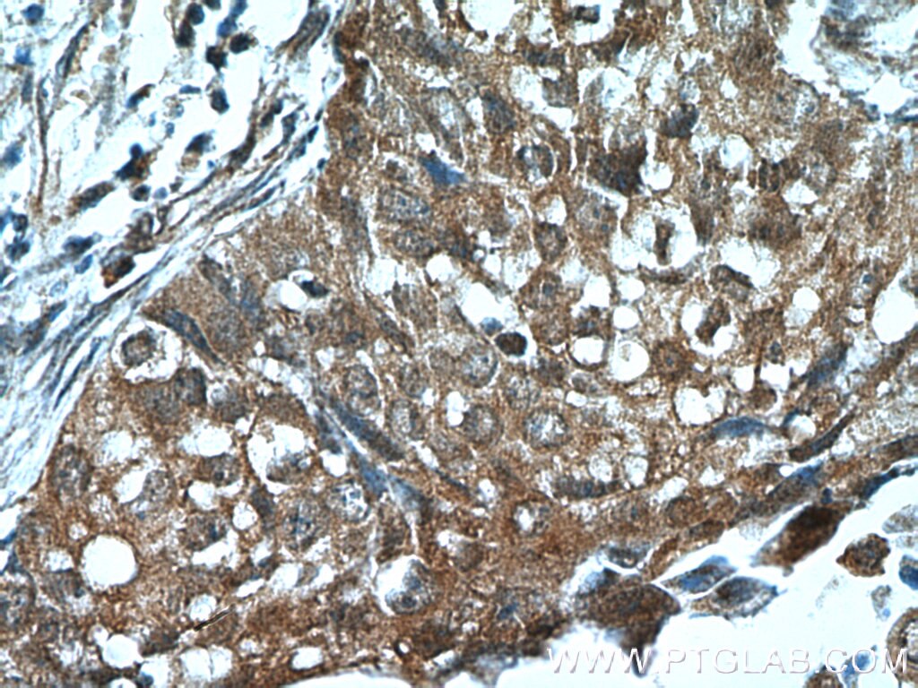 Immunohistochemistry (IHC) staining of human lung cancer tissue using Cytokeratin 14 Polyclonal antibody (22221-1-AP)