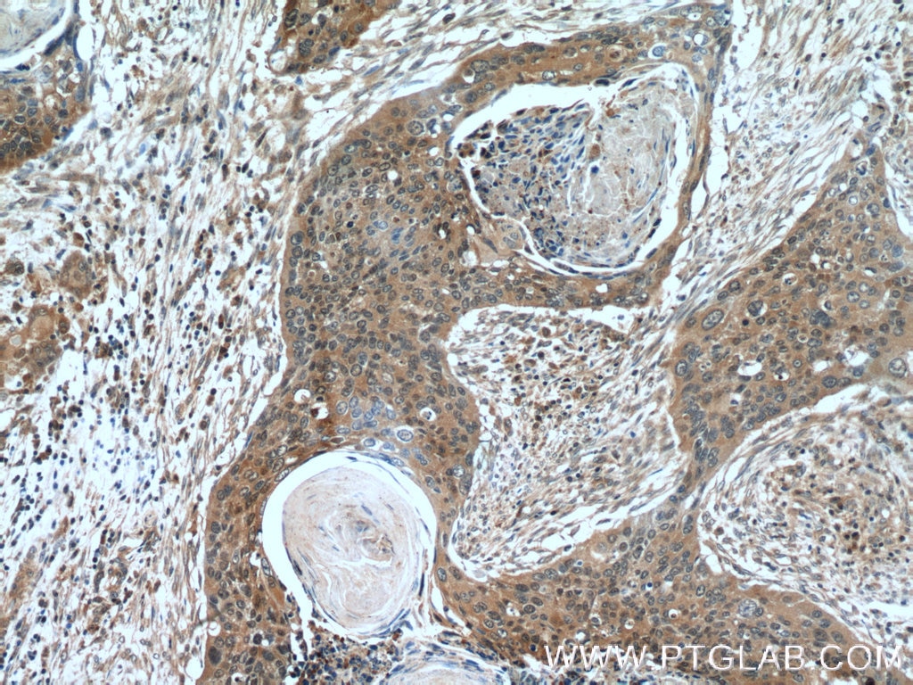 IHC staining of human cervical cancer using 22221-1-AP