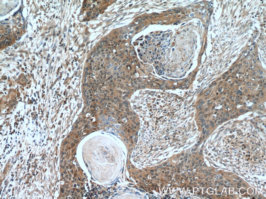 Immunohistochemistry (IHC) staining of human cervical cancer tissue using Cytokeratin 14 Polyclonal antibody (22221-1-AP)