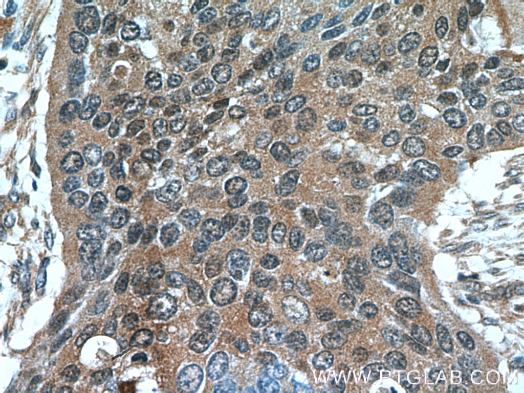 Immunohistochemistry (IHC) staining of human cervical cancer tissue using Cytokeratin 14 Polyclonal antibody (22221-1-AP)