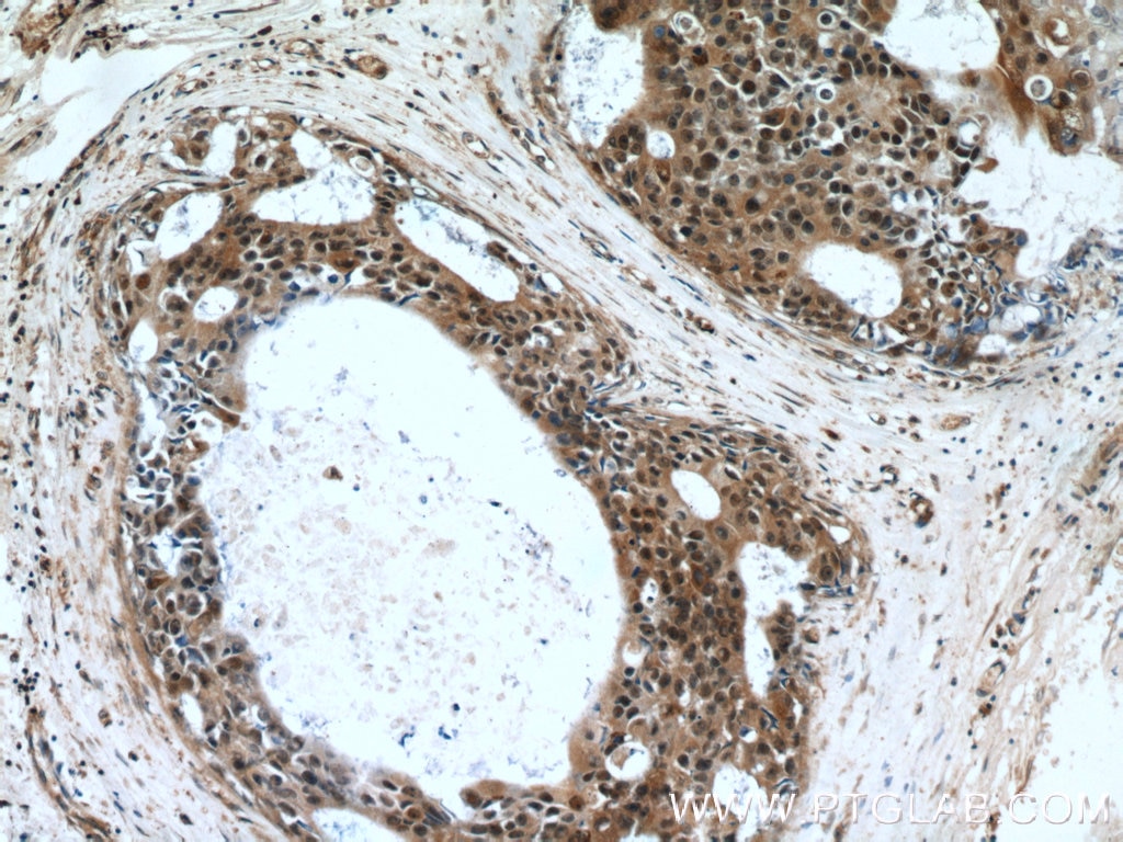 Immunohistochemistry (IHC) staining of human breast cancer tissue using Cytokeratin 14 Polyclonal antibody (22221-1-AP)