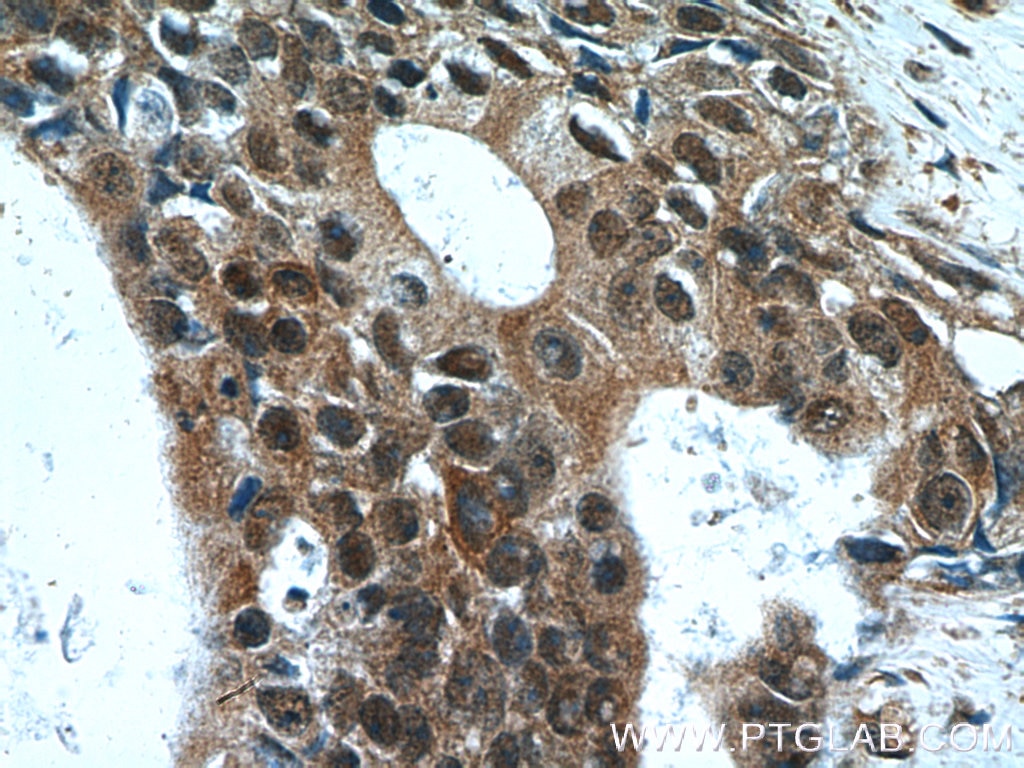 Immunohistochemistry (IHC) staining of human breast cancer tissue using Cytokeratin 14 Polyclonal antibody (22221-1-AP)