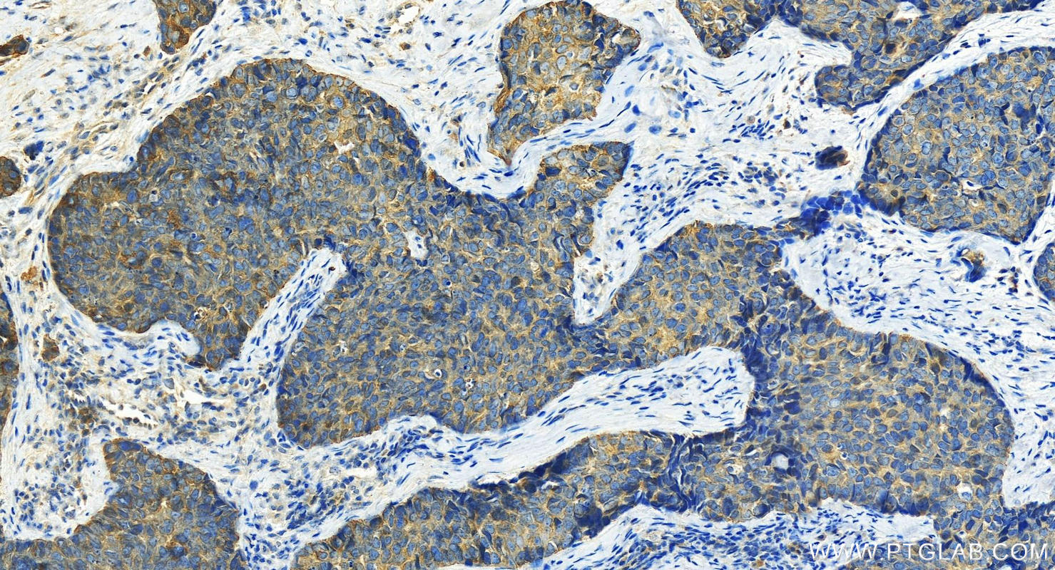 Immunohistochemistry (IHC) staining of human bowen disease using Cytokeratin 14 Polyclonal antibody (22221-1-AP)
