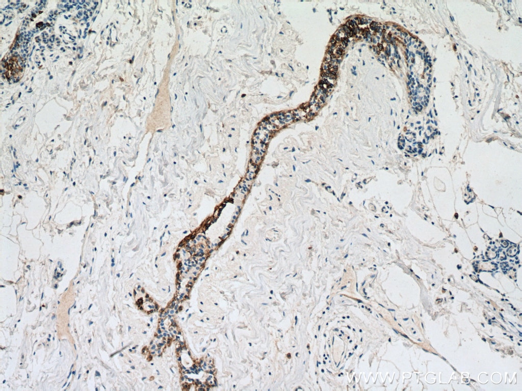 Immunohistochemistry (IHC) staining of human breast hyperplasia tissue using Cytokeratin 14 Monoclonal antibody (60320-1-Ig)