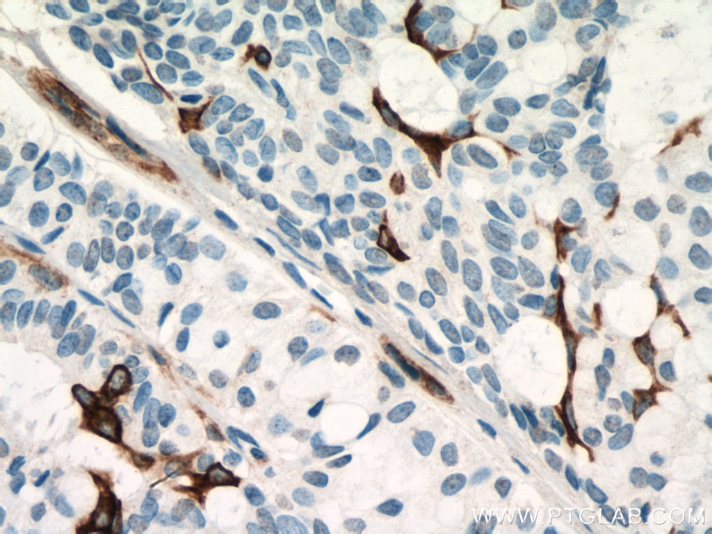 Immunohistochemistry (IHC) staining of human breast hyperplasia tissue using Cytokeratin 14 Monoclonal antibody (60320-1-Ig)