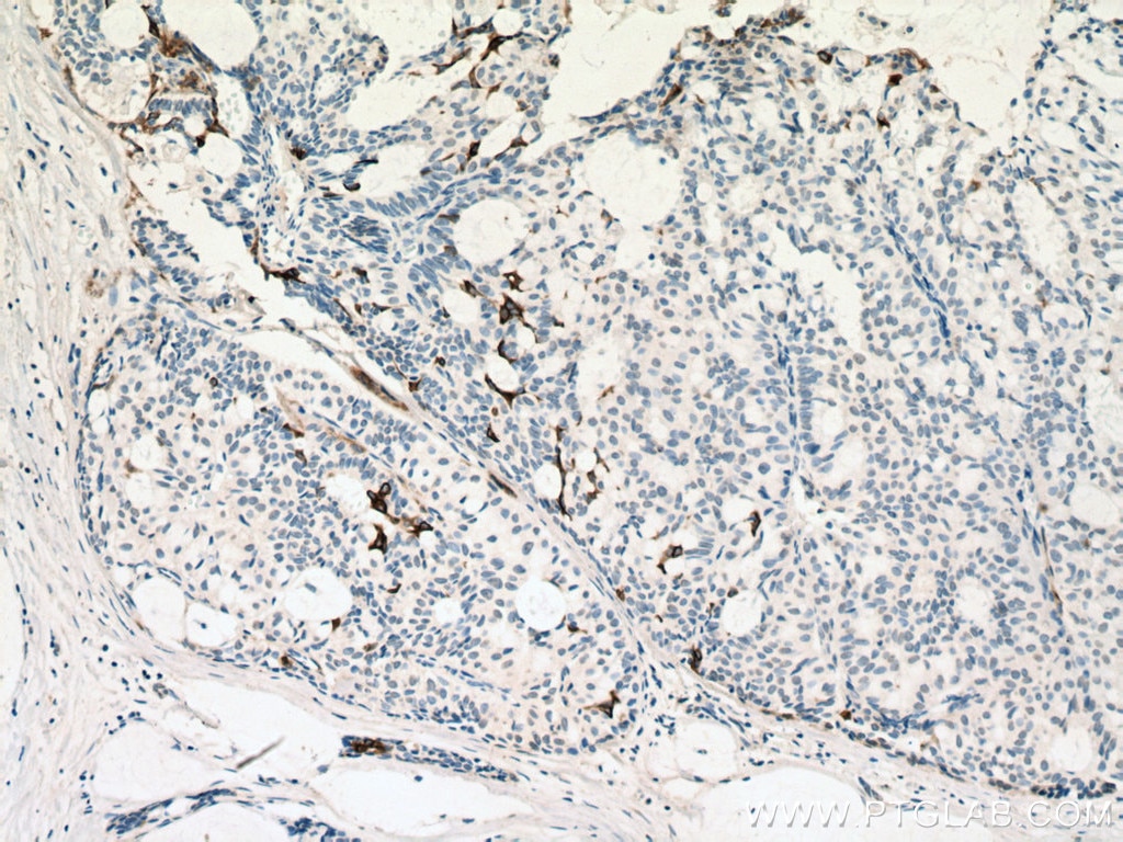 IHC staining of human breast hyperplasia using 60320-1-Ig