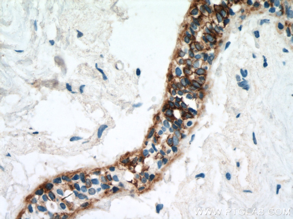 Immunohistochemistry (IHC) staining of human breast hyperplasia tissue using Cytokeratin 14 Monoclonal antibody (60320-1-Ig)