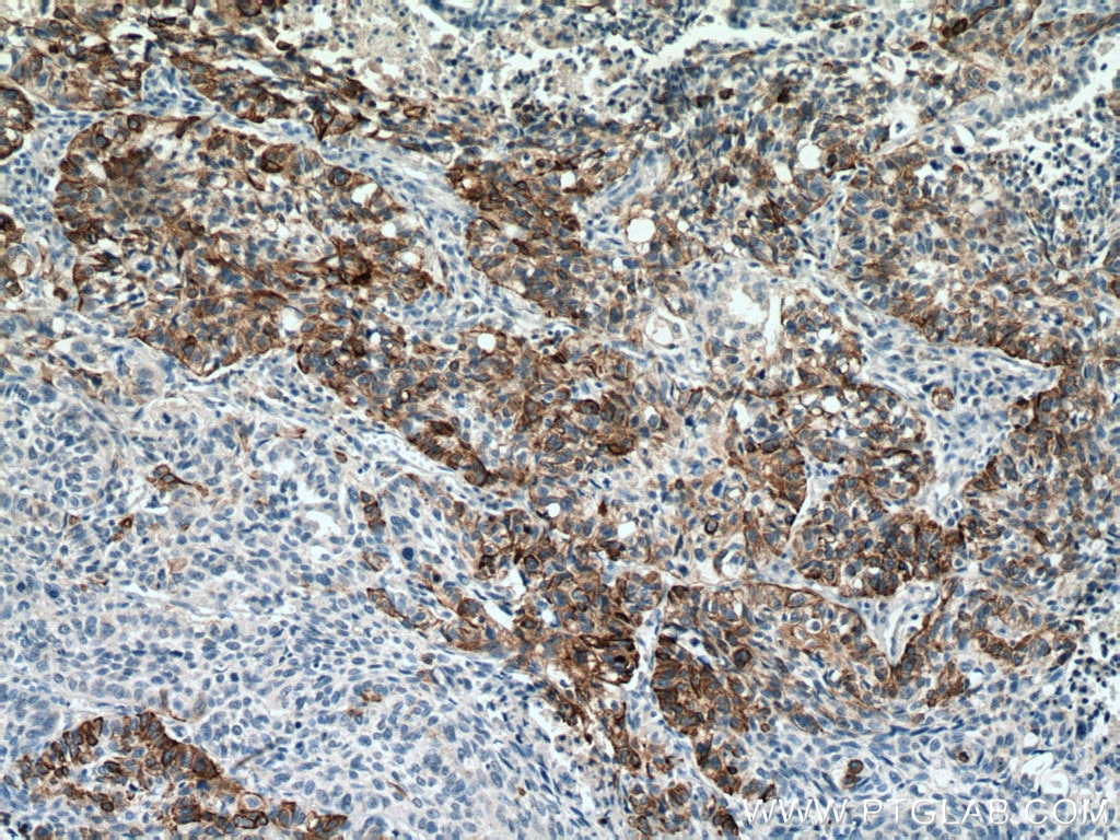 Immunohistochemistry (IHC) staining of human lung cancer tissue using Cytokeratin 14 Monoclonal antibody (60320-1-Ig)