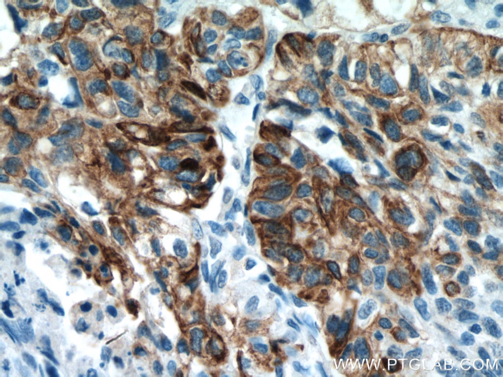 Immunohistochemistry (IHC) staining of human lung cancer tissue using Cytokeratin 14 Monoclonal antibody (60320-1-Ig)