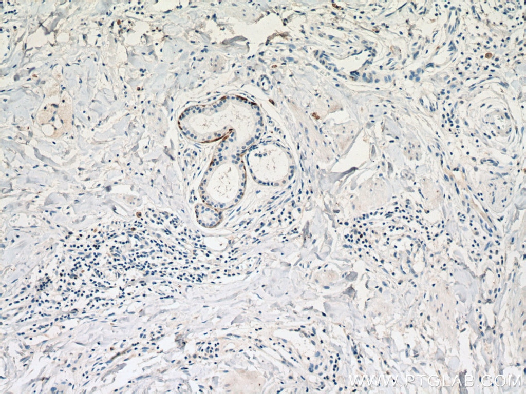 Immunohistochemistry (IHC) staining of human skin cancer tissue using Cytokeratin 14 Monoclonal antibody (60320-1-Ig)