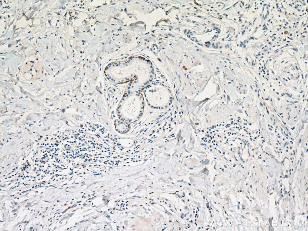 IHC staining of human skin cancer using 60320-1-Ig