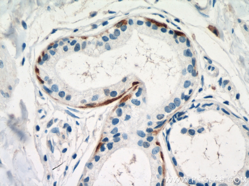 Immunohistochemistry (IHC) staining of human skin cancer tissue using Cytokeratin 14 Monoclonal antibody (60320-1-Ig)