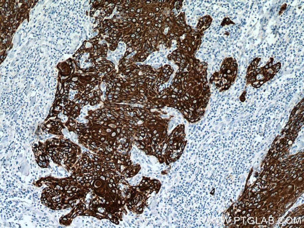 Immunohistochemistry (IHC) staining of human skin cancer tissue using Cytokeratin 14 Monoclonal antibody (60320-1-Ig)