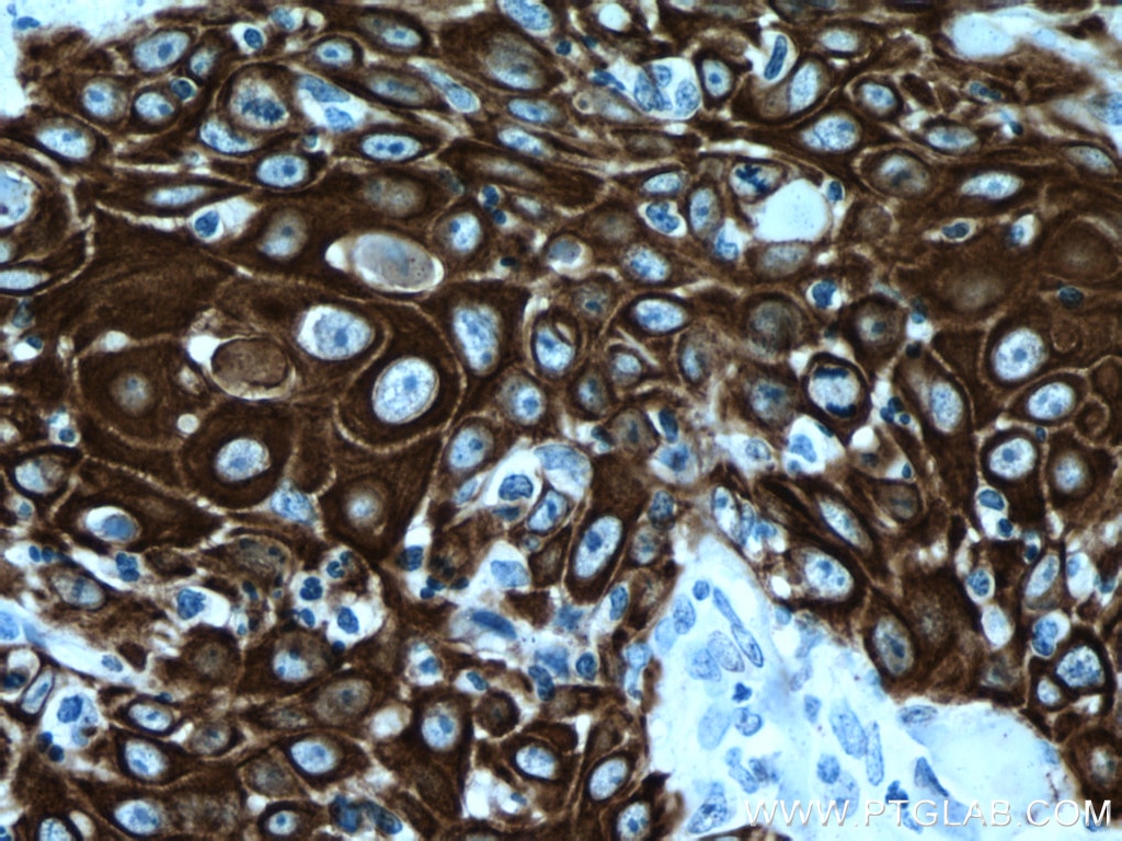 Immunohistochemistry (IHC) staining of human skin cancer tissue using Cytokeratin 14 Monoclonal antibody (60320-1-Ig)