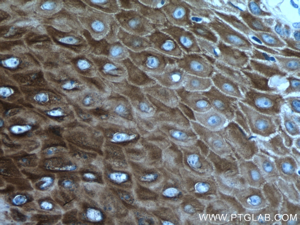 IHC staining of human skin cancer using 60320-1-Ig