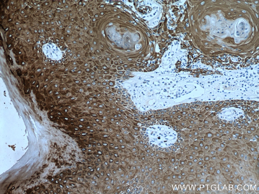 Immunohistochemistry (IHC) staining of human skin cancer tissue using Cytokeratin 14 Monoclonal antibody (60320-1-Ig)