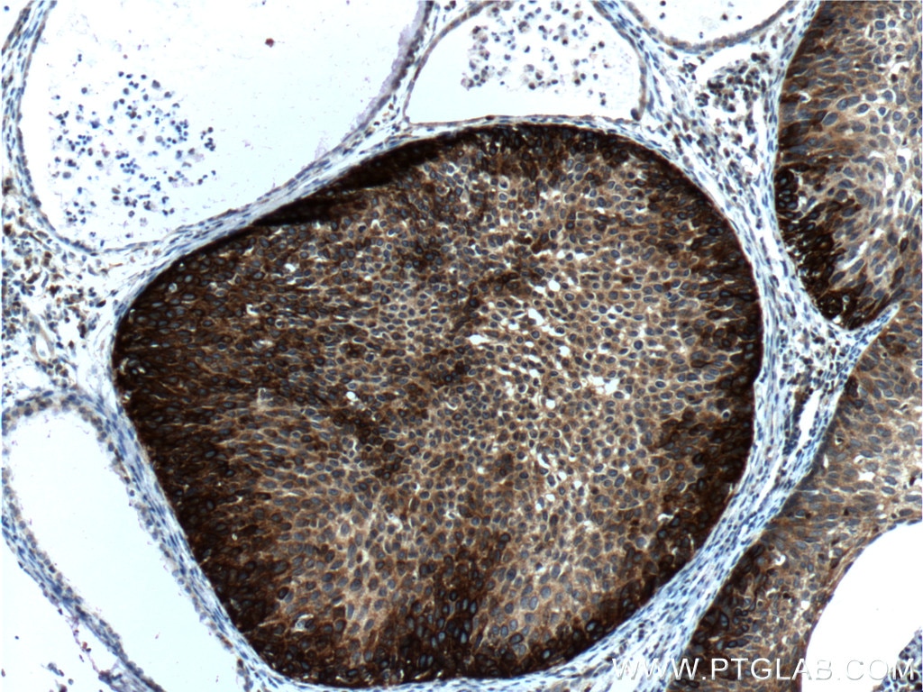 Immunohistochemistry (IHC) staining of human cervical cancer tissue using Cytokeratin 14 Monoclonal antibody (60320-1-Ig)