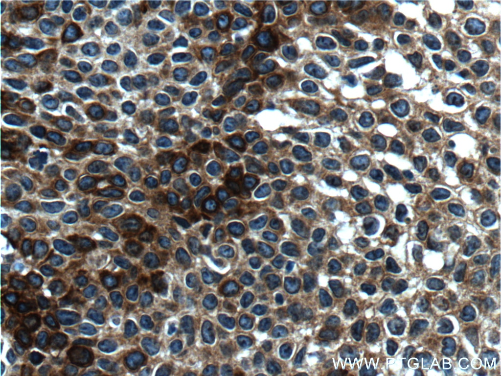 Immunohistochemistry (IHC) staining of human cervical cancer tissue using Cytokeratin 14 Monoclonal antibody (60320-1-Ig)