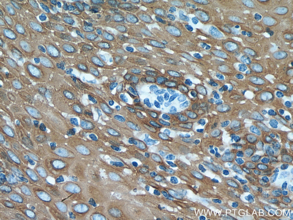 Immunohistochemistry (IHC) staining of human oesophagus cancer tissue using Cytokeratin 15 Polyclonal antibody (10137-1-AP)