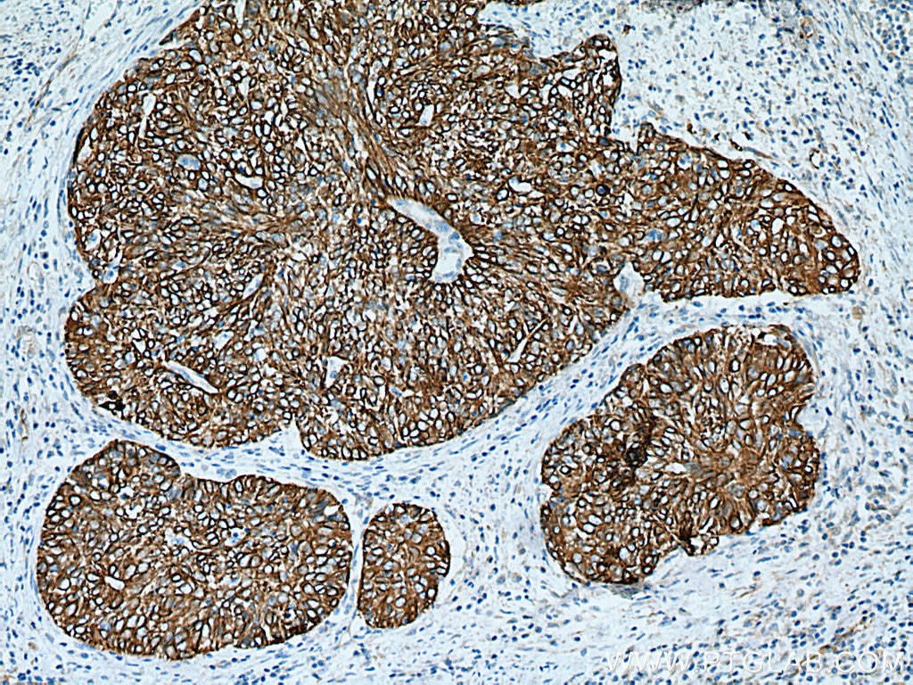 Immunohistochemistry (IHC) staining of human cervical cancer tissue using Cytokeratin 15 Polyclonal antibody (10137-1-AP)