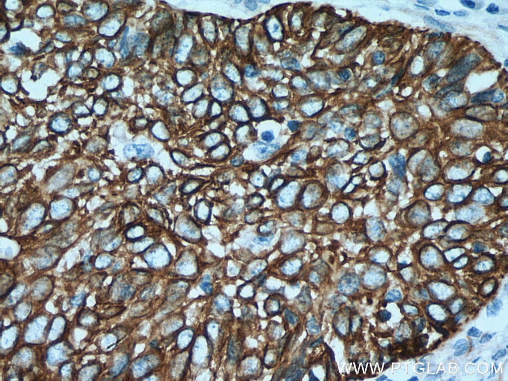 Immunohistochemistry (IHC) staining of human cervical cancer tissue using Cytokeratin 15 Polyclonal antibody (10137-1-AP)