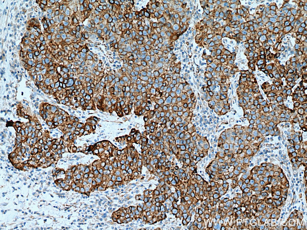 Immunohistochemistry (IHC) staining of human breast cancer tissue using Cytokeratin 15 Polyclonal antibody (10137-1-AP)