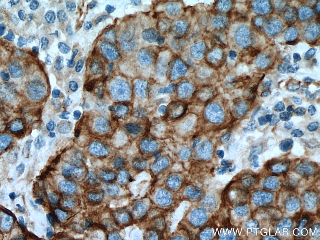 Immunohistochemistry (IHC) staining of human breast cancer tissue using Cytokeratin 15 Polyclonal antibody (10137-1-AP)