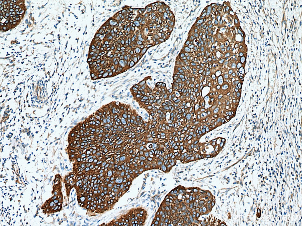 Immunohistochemistry (IHC) staining of human oesophagus cancer tissue using Cytokeratin 15 Polyclonal antibody (10137-1-AP)