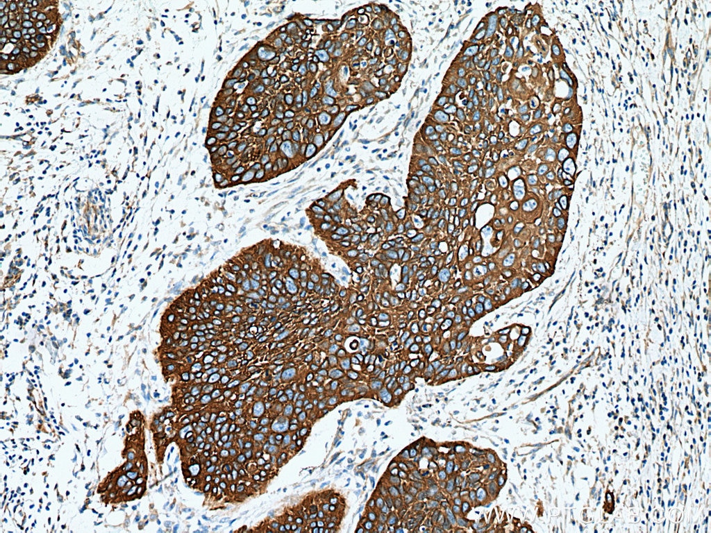 IHC staining of human oesophagus cancer using 10137-1-AP