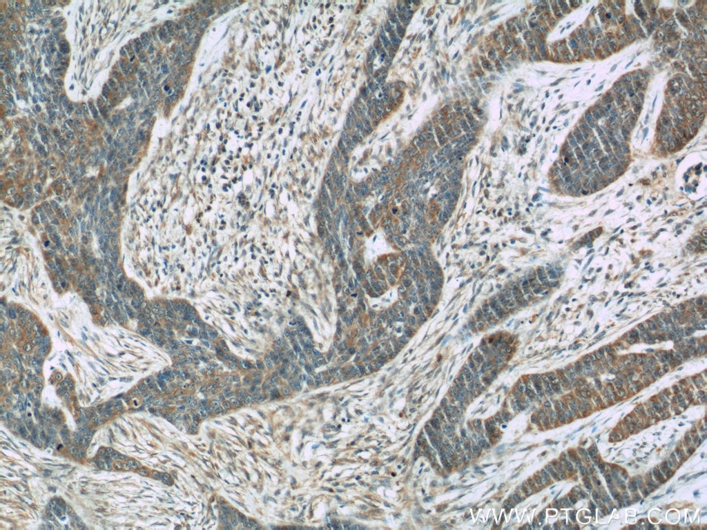 Immunohistochemistry (IHC) staining of human skin cancer tissue using Cytokeratin 15 Monoclonal antibody (60247-1-Ig)