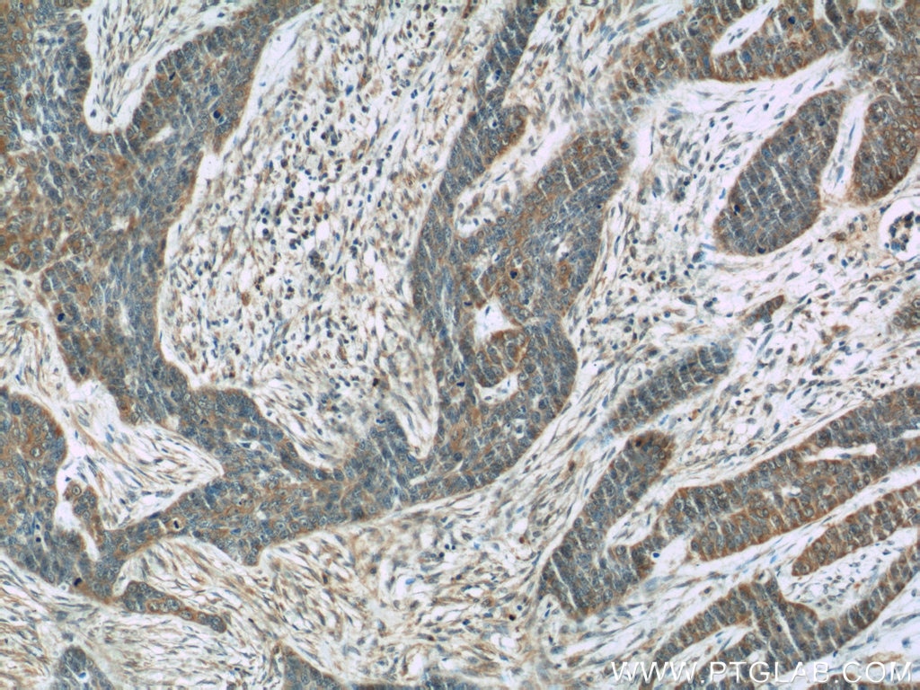 IHC staining of human skin cancer using 60247-1-Ig