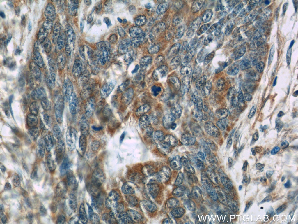 Immunohistochemistry (IHC) staining of human skin cancer tissue using Cytokeratin 15 Monoclonal antibody (60247-1-Ig)