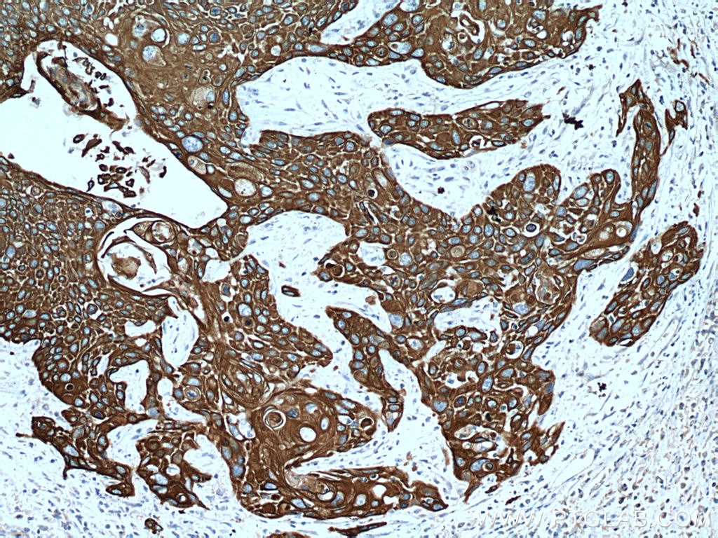 Immunohistochemistry (IHC) staining of human oesophagus cancer tissue using Cytokeratin 15 Monoclonal antibody (60247-1-Ig)